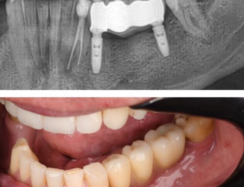 Kako izabrati pravo rješenje za gubitak zuba