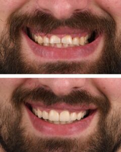 Detaljan pogled na zube s cirkonkeramičkim krunicama