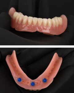 Overdenture proteza s implantatima