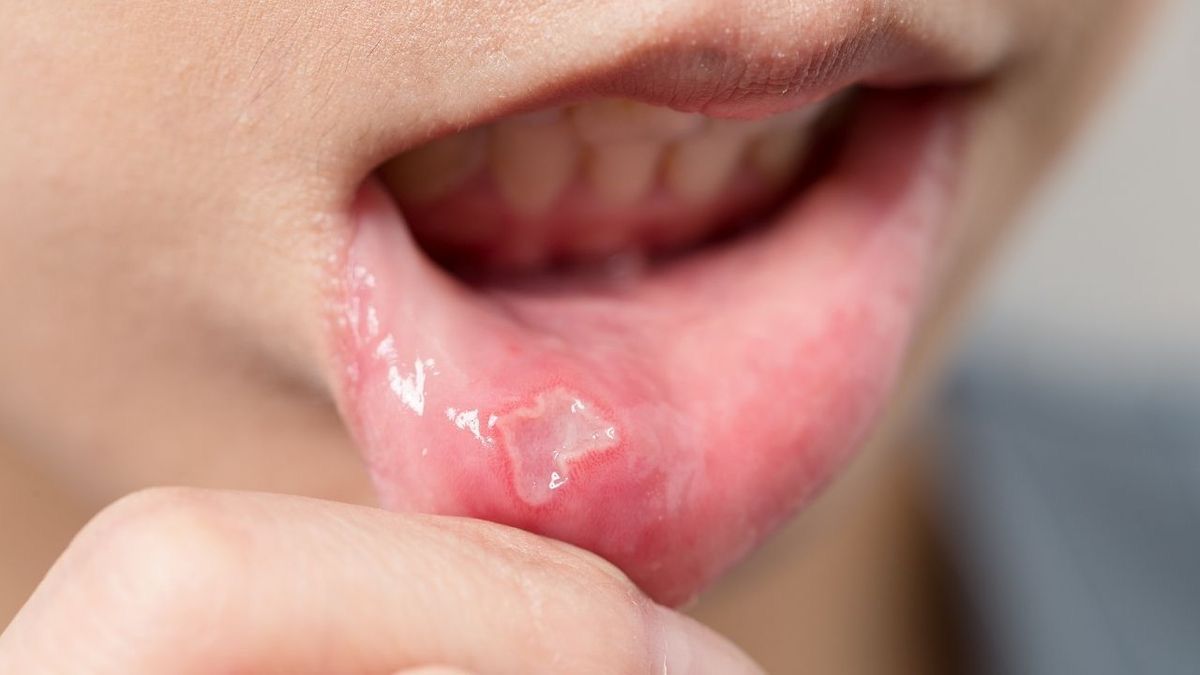 Afte u ustima na unutarnjoj strani usne