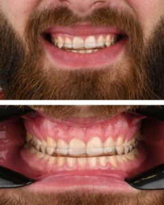 Bruksizam tragovi trošenja zuba zbog škripanja