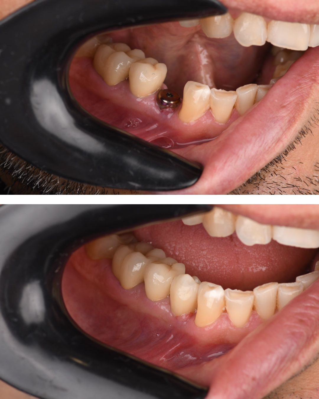 Implantat ili most: kako odabrati najbolje rješenje