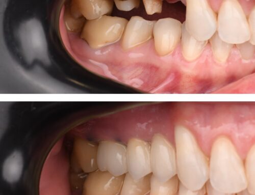 Dentalna protetika bez nejasnoća: osnovni pojmovi koje vrijedi znati