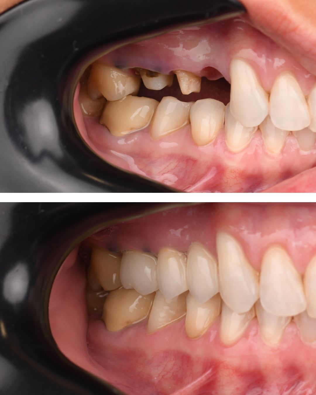 Dentalna protetika bez nejasnoća: osnovni pojmovi koje vrijedi znati