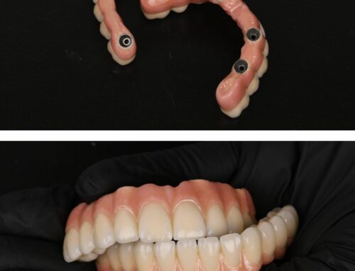 Fiksni zubi na implantatima: kome su najbolje rješenje
