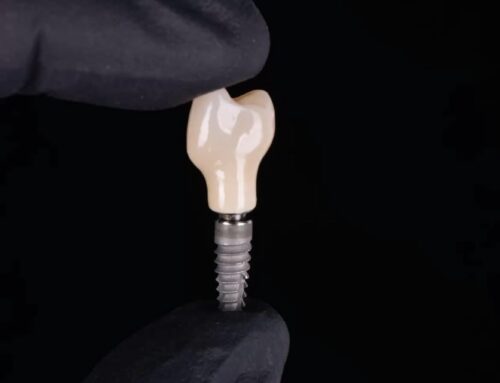 Dentalni implantati – Nobel Biocare