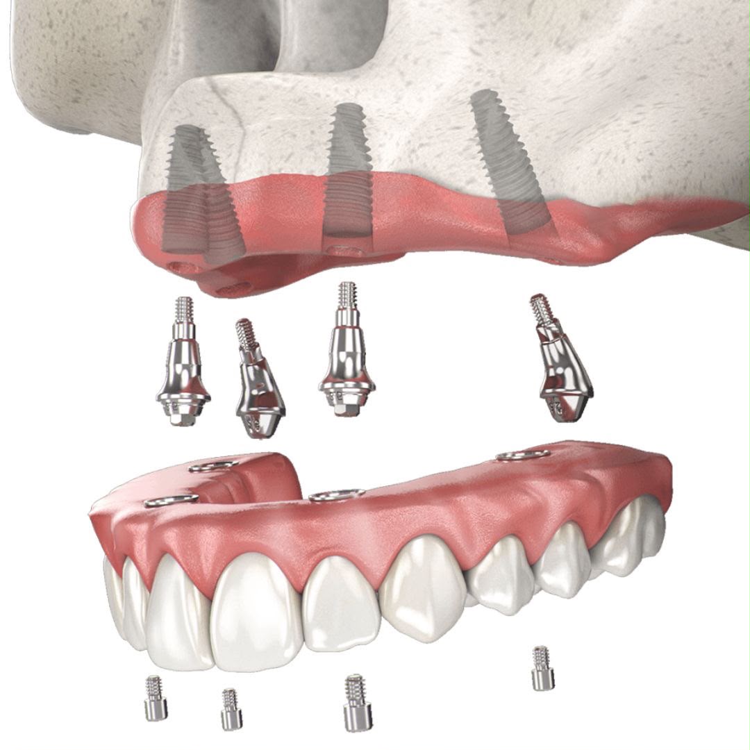 image2 Dentalni implantati Nobel Biocare i protetski prikaz