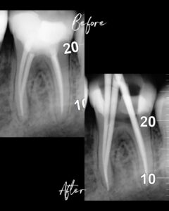 Kolaž prikazuje dvije dentalne rendgenske snimke istog kutnjaka, označene kao prije i poslije endodontskog zahvata. Na obje snimke vide se korijenski kanali ispunjeni svijetlim materijalom, uz brojčan